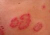 Dermatitis herpetiforme