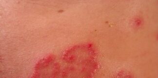 Dermatitis herpetiforme