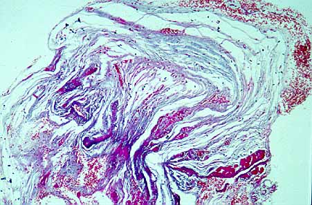 fibrosis endomiocardica