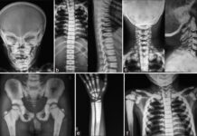 Agradecemos a https://www.ijmdent.com/article.asp?issn=2229-6360;year=2018;volume=8;issue=1;spage=44;epage=47;aulast=Bhattacharjee por la foto