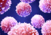 Enfermedad linfoproliferativa post-trasplante