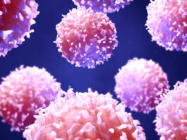 Enfermedad linfoproliferativa post-trasplante