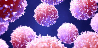Enfermedad linfoproliferativa post-trasplante
