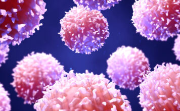 Enfermedad linfoproliferativa post-trasplante