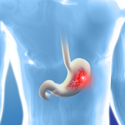 tumor estroma gastrointestinal