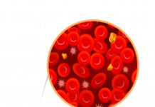 Leucemia de células peludas variante