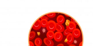 Leucemia de células peludas variante