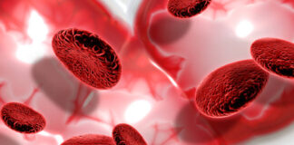 Leucemia de células peludas