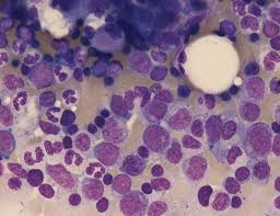 leucemia mastocitica