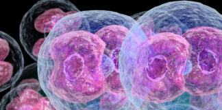 Mielofibrosis con metaplasia mieloide