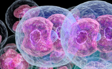 Mielofibrosis con metaplasia mieloide