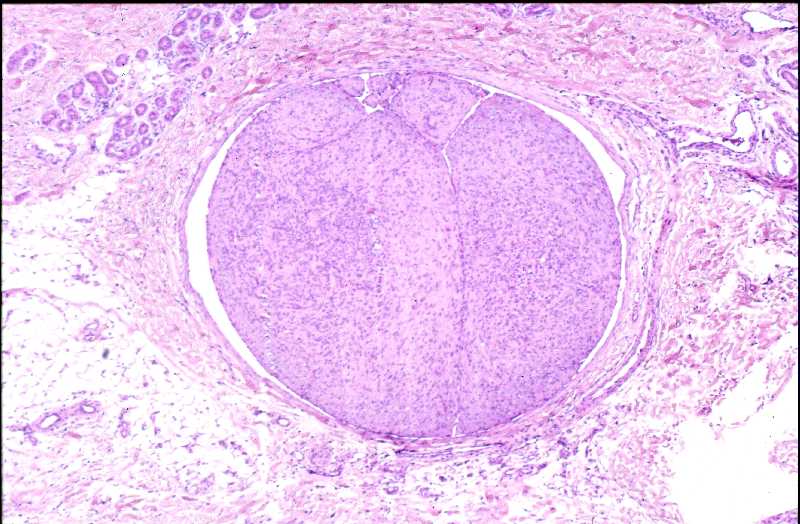 miofibromatosis infantil