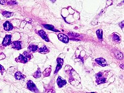 liposarcoma