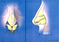 nariz bífida