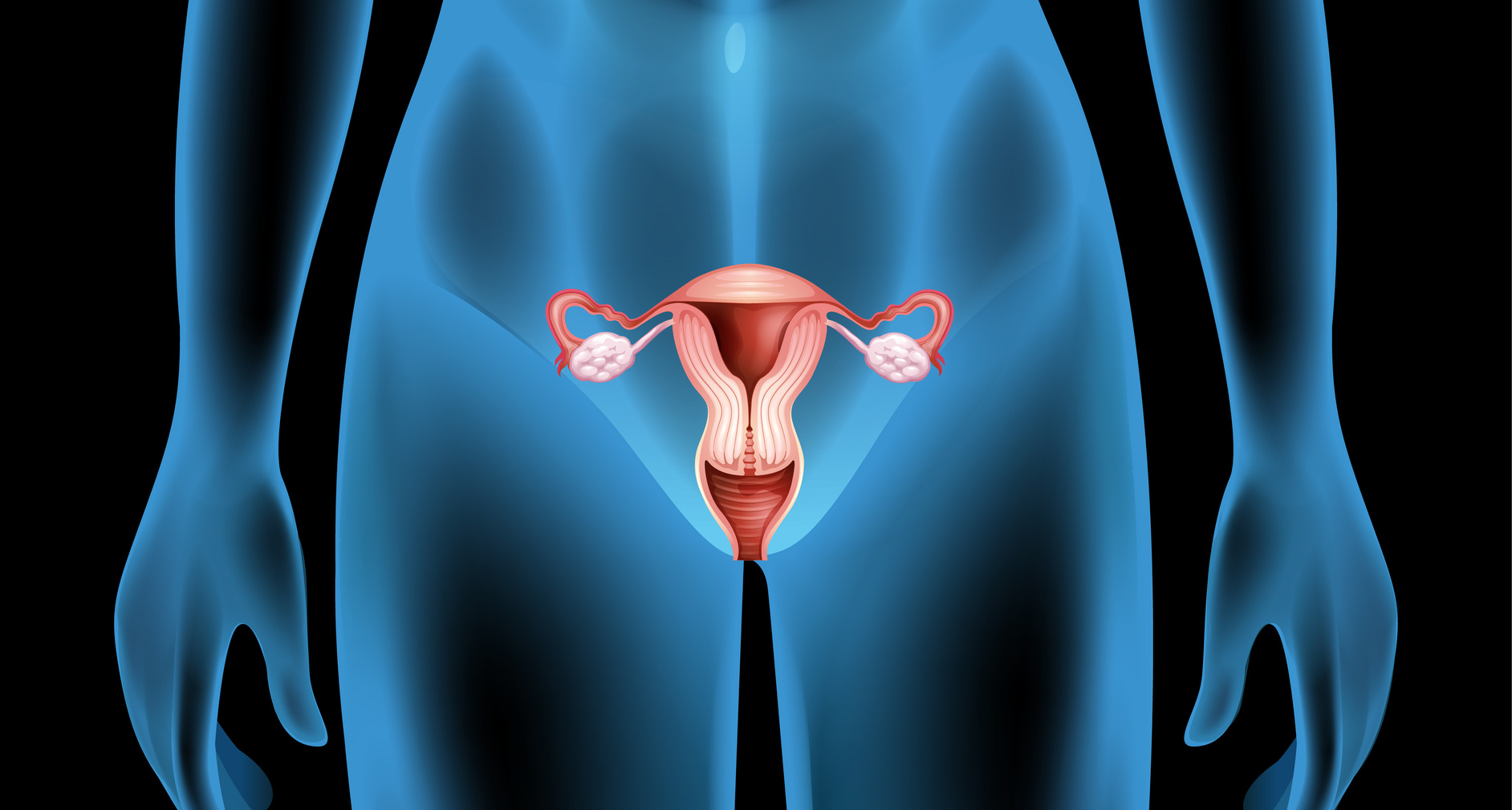 Ovarios poliquísticos - disfunción del esfínter uretral