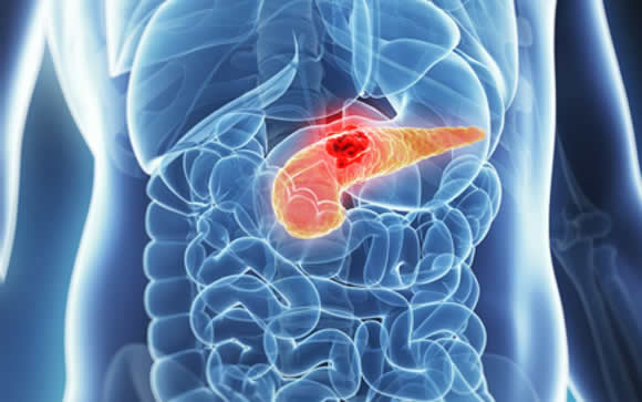 Pancreatitis tropical