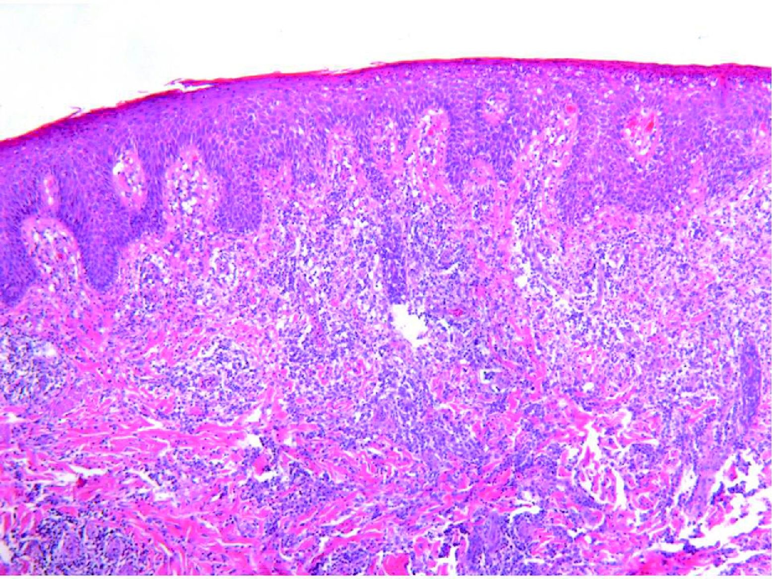 Papulosis linfomatoide