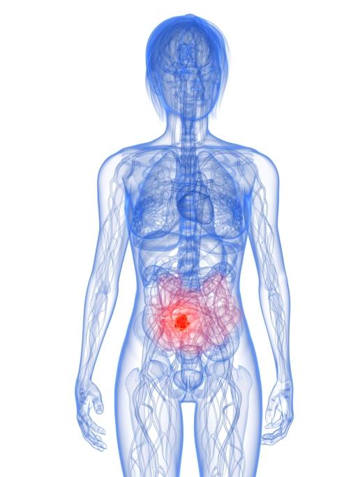 Pseudomixoma peritoneal