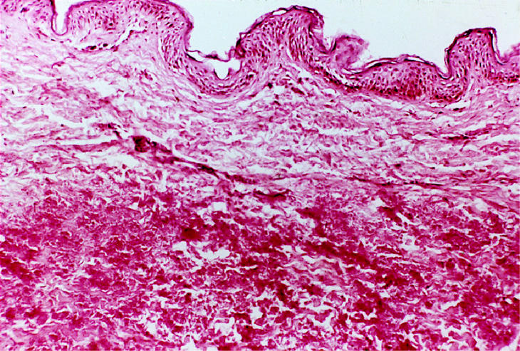 Pseudoxantoma elástico