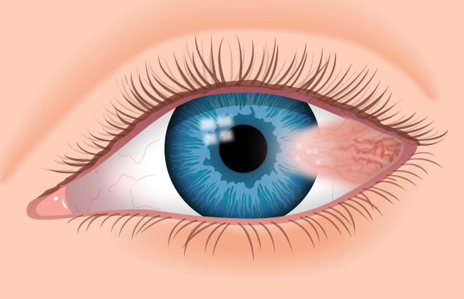 Pterygium de la conjuntiva