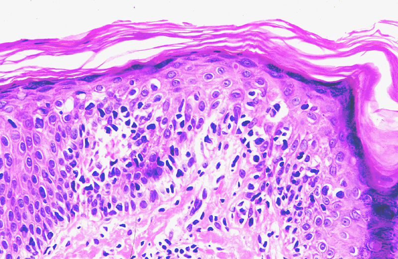 Reticulosis pagetoide localizada