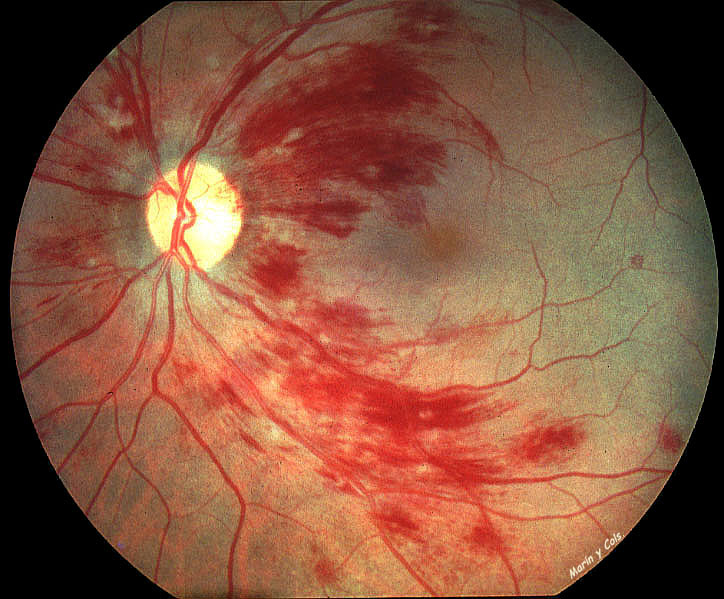 Retinopatía hereditaria vascular