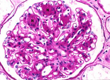 Enfermedad de la antimembrana basal glomerular