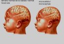 Microcefalia - anomalías digitales - deficiencia intelectual