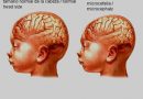 Microcefalia - anomalías digitales - deficiencia intelectual