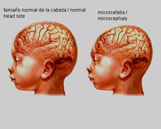 Microcefalia - anomalías digitales - deficiencia intelectual