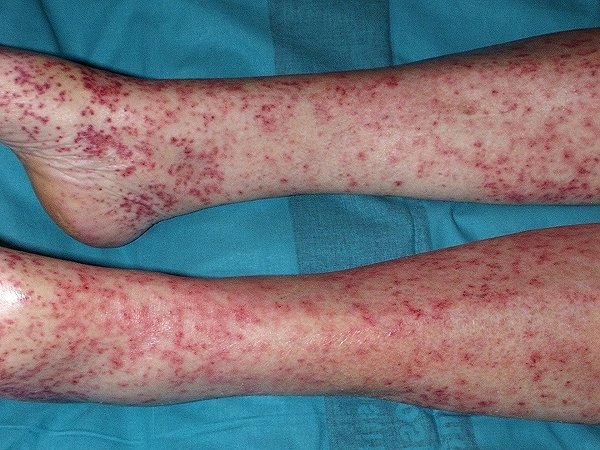 Vasculitis urticarial hipocomplementémica