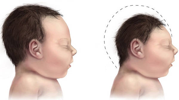 Síndrome óculo-cerebro-facial tipo Kaufman