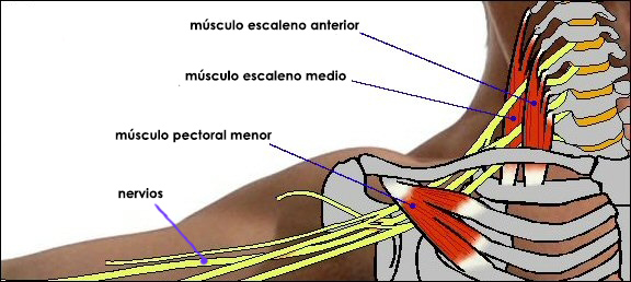 Síndrome venoso de la salida torácica