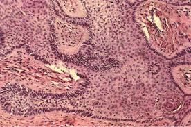 Tricofoliculoma