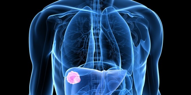 Carcinoma neuroendocrino hepático primario