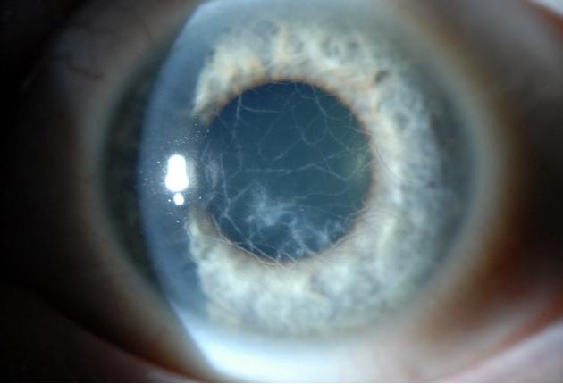 Distrofia corneal endotelial ligada al X