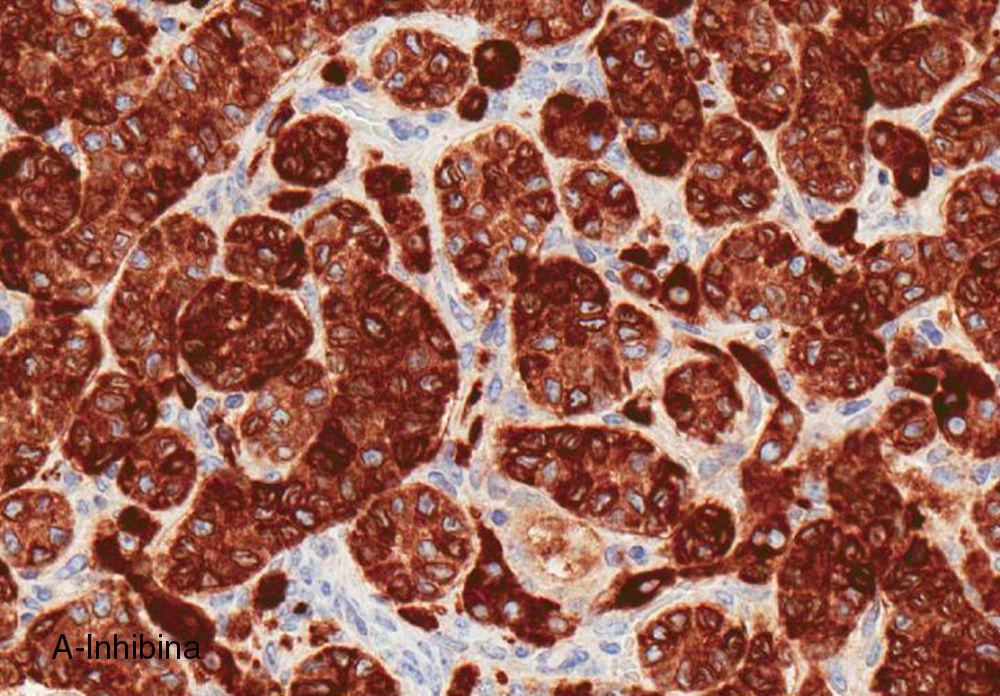 Tumor ovárico maligno de las células de Sertoli-Leydig