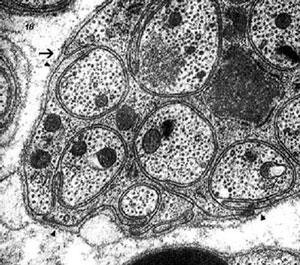 El tumor tritón maligno (MTT) es un subtipo agresivo raro de tumor maligno de la vaina nerviosa periférica (MPNST; consulte este término) caracterizado histopatológicamente por diferenciación rabdomioblástica focal.