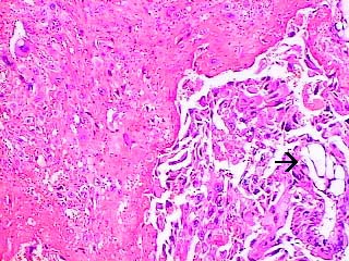 Tumor trofoblástico epitelioide