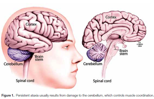 Ataxia de Friedreich