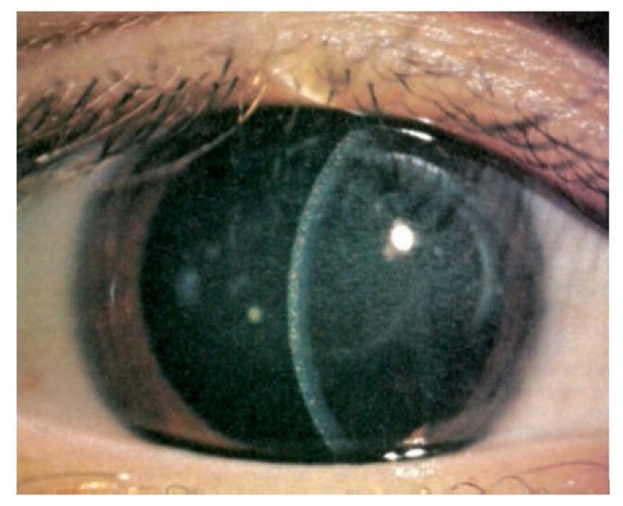 Cistinosis ocular