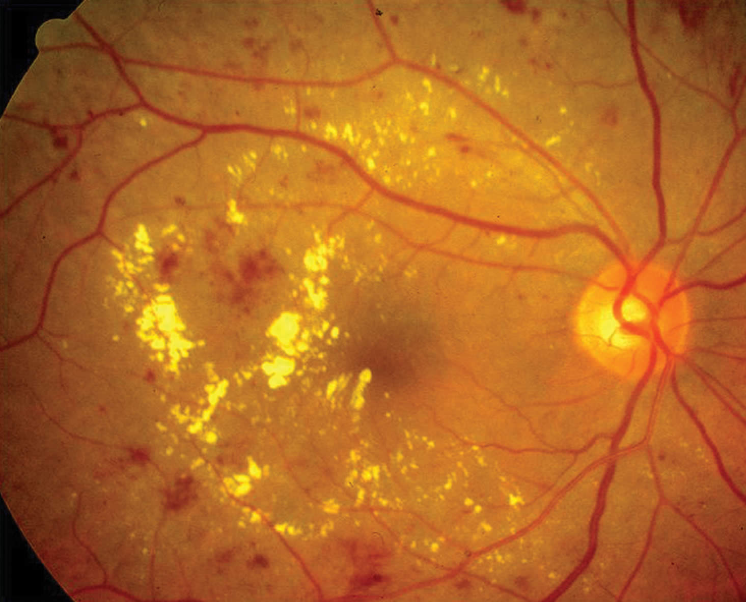 Distrofia macular cistoide