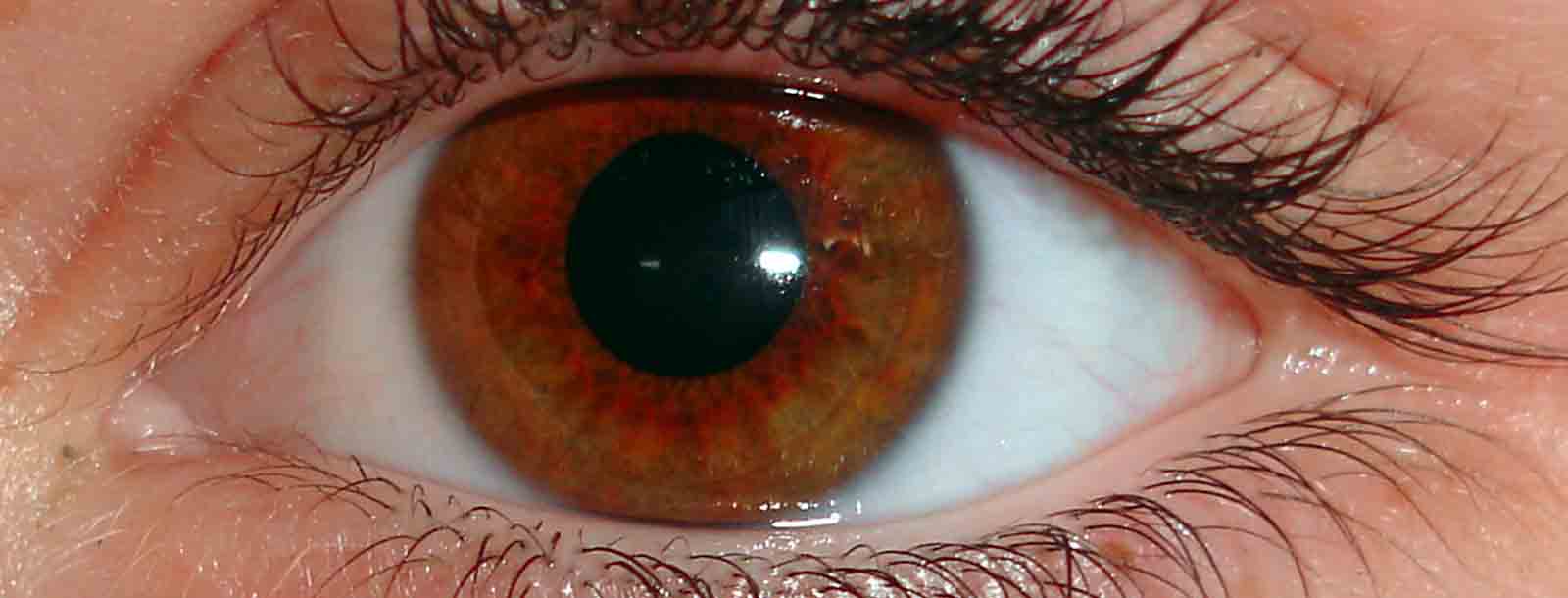 Distrofia reticular del epitelio pigmentario de la retina