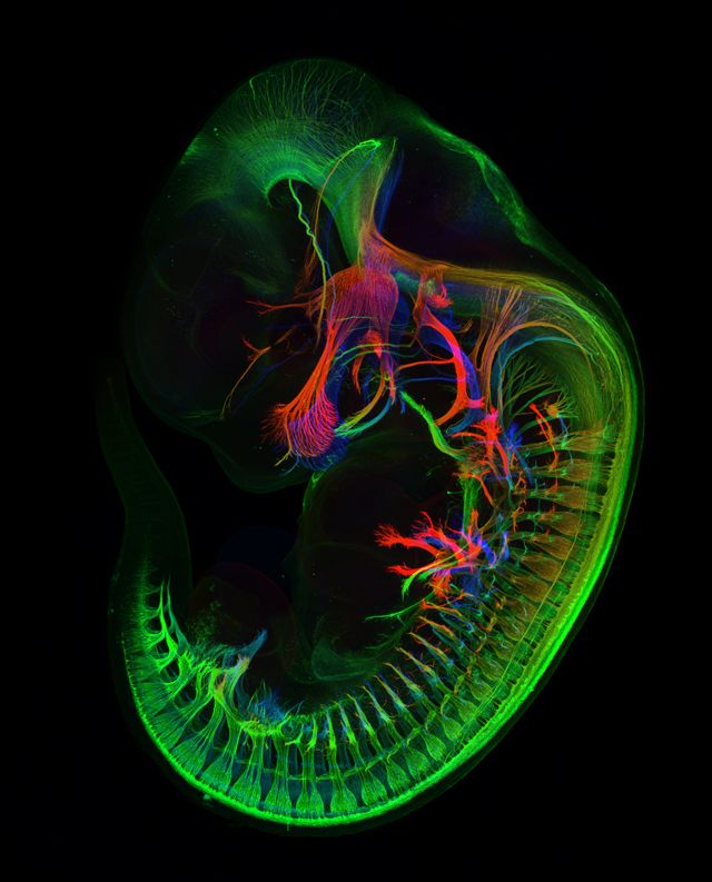 Foramina parietal ampliada