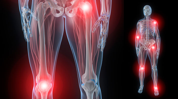 Melorreostosis con osteopoiquilia