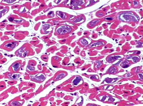 Enfermedad de almacenamiento de glucógeno por deficiencia de glucógeno sintasa hepática