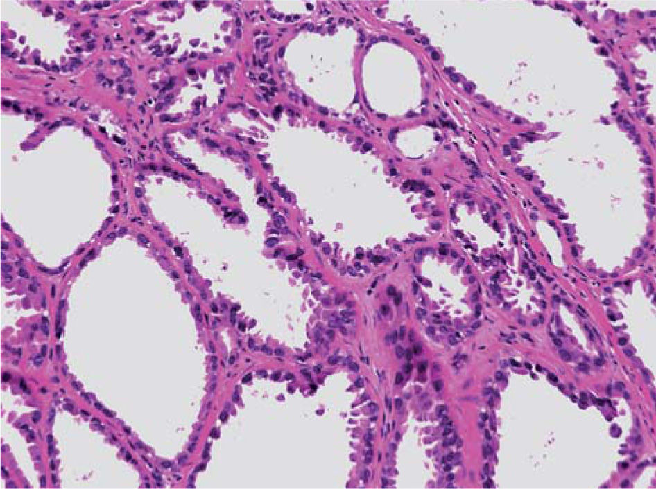 Enfermedad renal quística medular autosómica dominante con o sin hiperuricemia