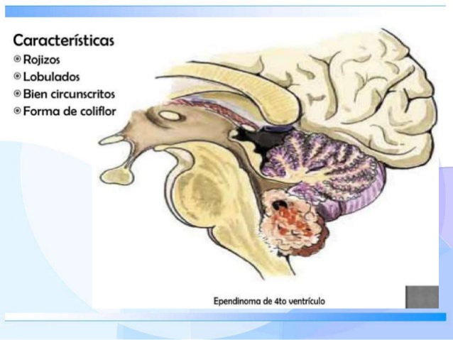 Ependimoma