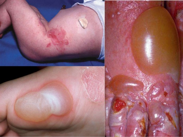 Epidermólisis ampollosa juntural generalizada tipo no Herlitz