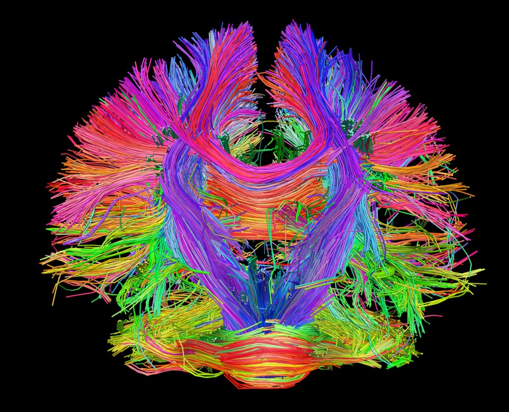 Epilepsia progresiva - deficiencia intelectual, tipo finlandés